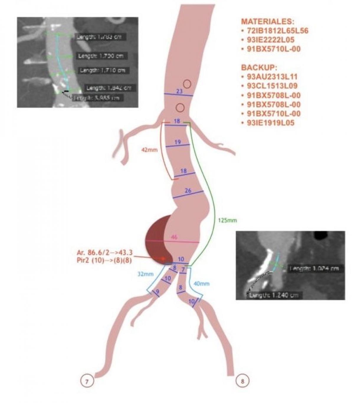 Cirugía de la Aorta, y Endovascular